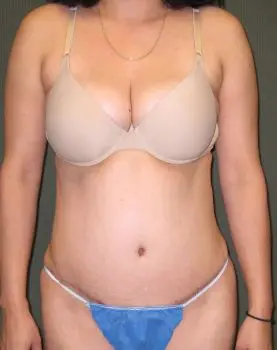 Tummy Tuck Patient Photo - Case 128 - after view