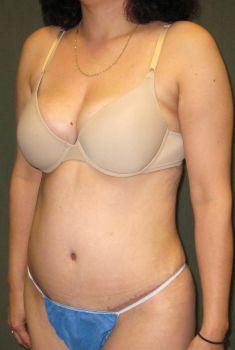 Tummy Tuck Patient Photo - Case 128 - after view-2