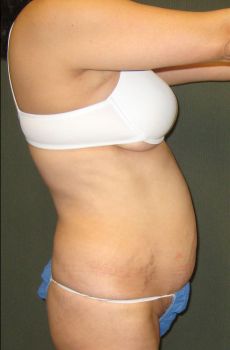 Liposuction Patient Photo - Case 128 - before view-1