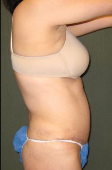 Tummy Tuck Patient Photo - Case 128 - after view-1