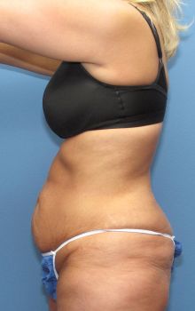 Tummy Tuck Patient Photo - Case 116 - before view-1