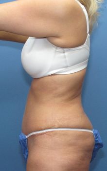 Liposuction Patient Photo - Case 116 - after view-1