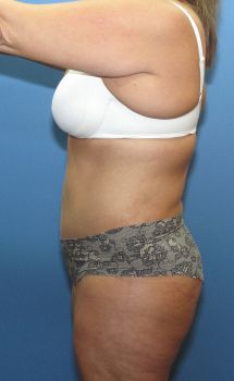 Tummy Tuck Patient Photo - Case 118 - after view-2