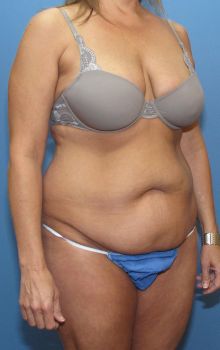 Tummy Tuck Patient Photo - Case 118 - before view-1