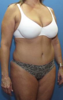 Liposuction Patient Photo - Case 118 - after view-1