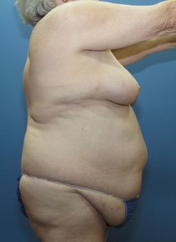 Liposuction Patient Photo - Case 121 - before view-1