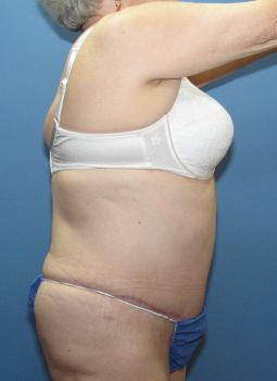 Liposuction Patient Photo - Case 121 - after view-1