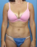 Liposuction - Case 122 - Before