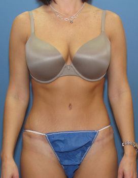 Liposuction Patient Photo - Case 122 - after view
