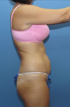 Liposuction Patient Photo - Case 122 - before view-1