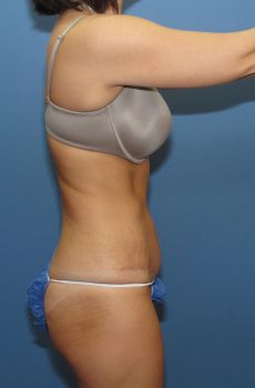 Tummy Tuck Patient Photo - Case 122 - after view-2