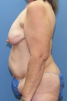 Liposuction Patient Photo - Case 123 - before view-1