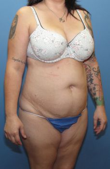 Tummy Tuck Patient Photo - Case 125 - before view-2