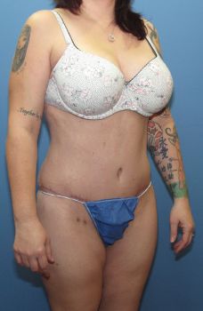 Tummy Tuck Patient Photo - Case 125 - after view-2