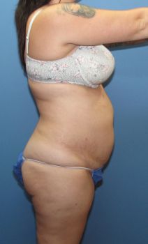 Liposuction Patient Photo - Case 125 - before view-1