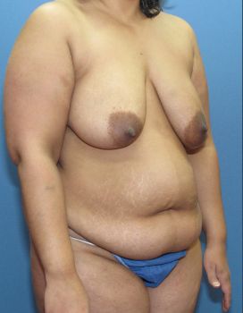 Liposuction Patient Photo - Case 127 - before view-2