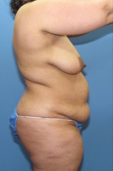 Tummy Tuck Patient Photo - Case 127 - before view-1