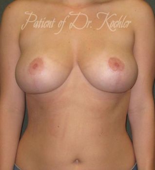 Breast Reduction Patient Photo - Case 70 - after view-0