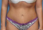 Tummy Tuck - Case 98 - After