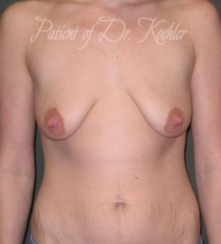 Breast Augmentation/Lift Patient Photo - Case 65 - before view-0
