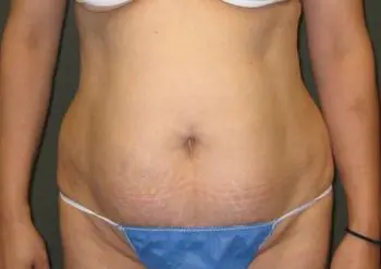 Tummy Tuck Patient Photo - Case 99 - before view-0