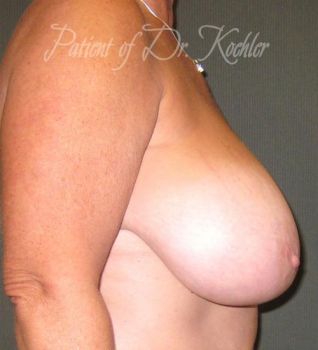 Breast Reduction Patient Photo - Case 68 - before view-1