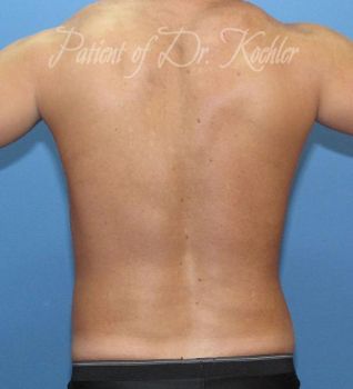 Liposuction Patient Photo - Case 83 - after view-2