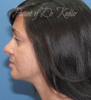 Rhinoplasty Patient Photo - Case 86 - before view-1