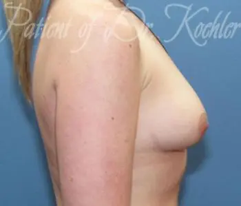 Breast Augmentation Patient Photo - Case 39 - before view-1
