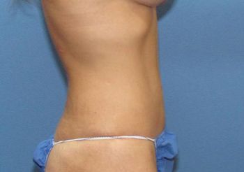 Tummy Tuck Patient Photo - Case 100 - after view-1
