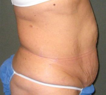 Tummy Tuck Patient Photo - Case 93 - before view-1