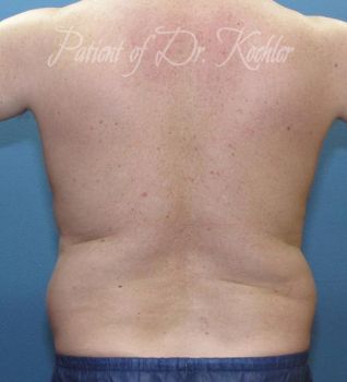 Liposuction Patient Photo - Case 81 - before view-2