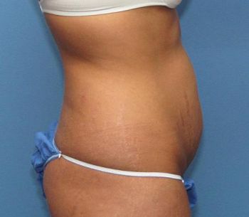 Liposuction Patient Photo - Case 98 - before view-1