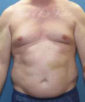 Gynecomastia/Male Chest Lift - Case 84 - Before