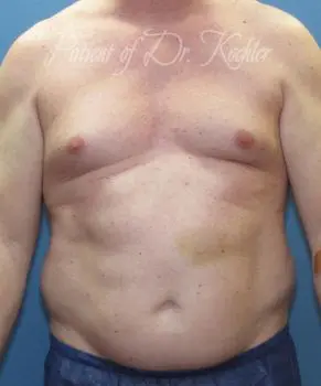 Breast Reduction Patient Photo - Case 84 - before view-