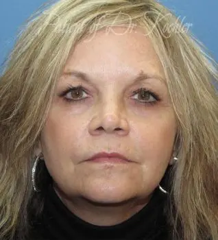 Brow Lift - Case 76 - Before