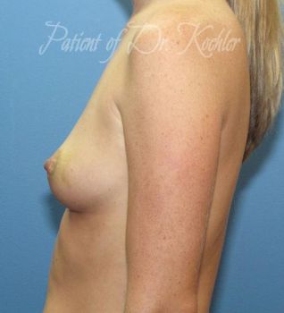 Breast Augmentation Patient Photo - Case 56 - before view-1