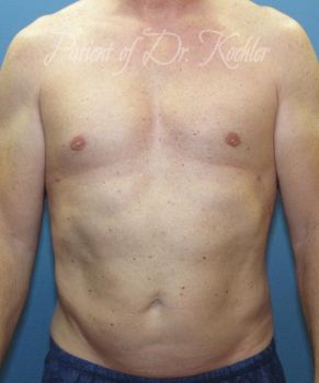 Gynecomastia Patient Photo - Case 84 - after view