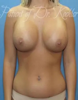 Breast Augmentation Patient Photo - Case 16 - after view