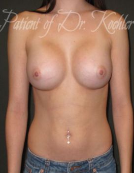 Breast Augmentation Patient Photo - Case 23 - after view-0