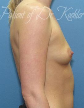 Breast Augmentation Patient Photo - Case 45 - before view-1