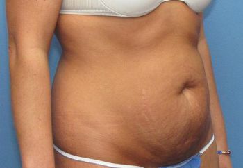 Tummy Tuck Patient Photo - Case 98 - before view-2