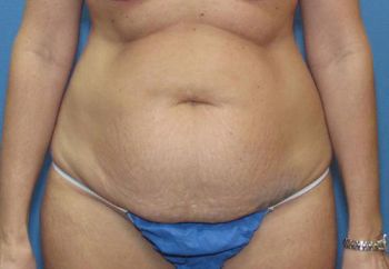 Tummy Tuck Patient Photo - Case 97 - before view-