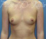 Breast Augmentation - Case 45 - Before