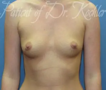 Breast Augmentation Patient Photo - Case 45 - before view-