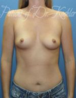Breast Augmentation - Case 44 - Before