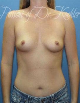 Breast Augmentation Patient Photo - Case 44 - before view-