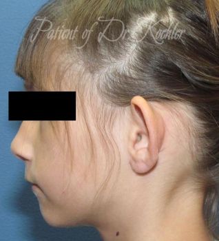 Ear Surgery Patient Photo - Case 75 - before view-1