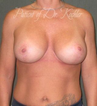 Breast Augmentation/Lift Patient Photo - Case 64 - after view