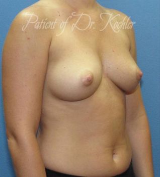 Breast Augmentation Patient Photo - Case 55 - before view-2